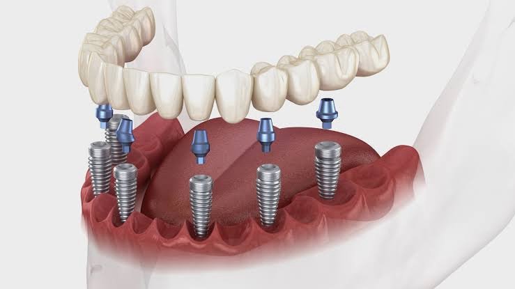 dental implant