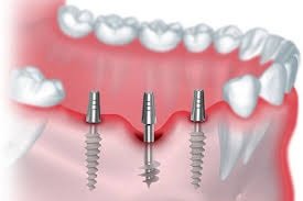 BASAL CORTICAL IMPLANTS