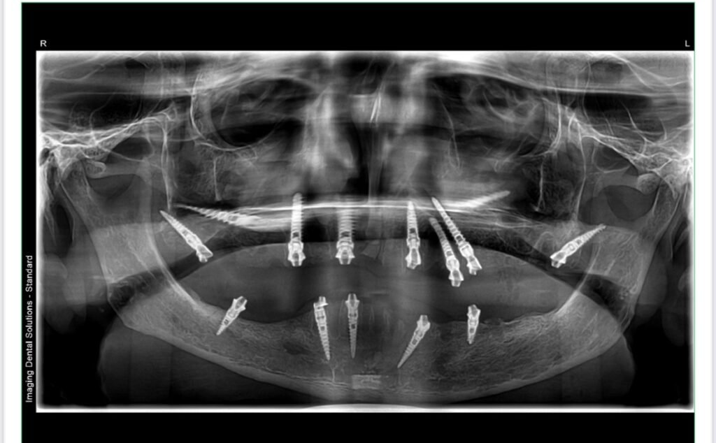 Full Mouth Immediate Loading Implants: A Beautiful Smile Restored in Just 5 Days - Dr. Manish Dighade | Expert Dental Care & Advanced Treatments img 8986 1